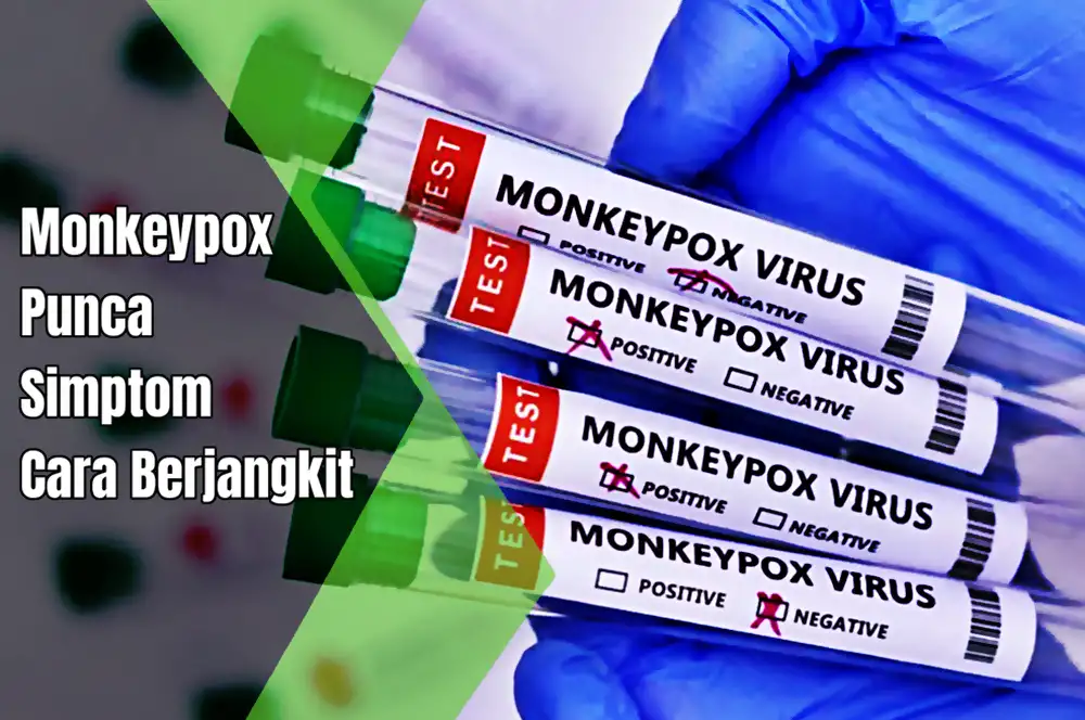 virus monkeypox cacar monyet