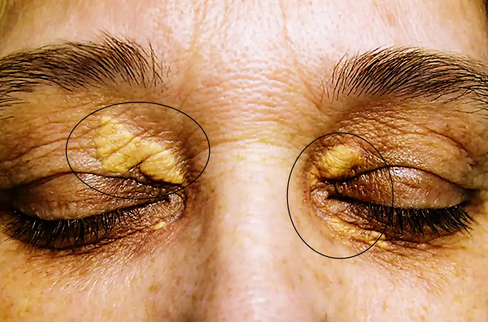 xanthelasma